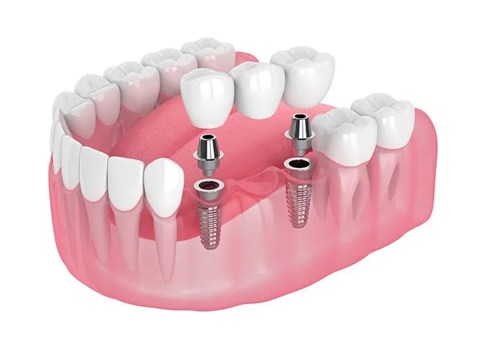 Dental Bridge Implant Supported