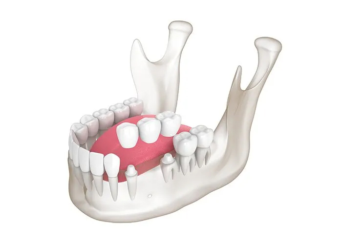 Traditional Dental Bridge