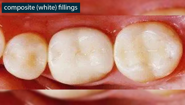 composite (white) fillings