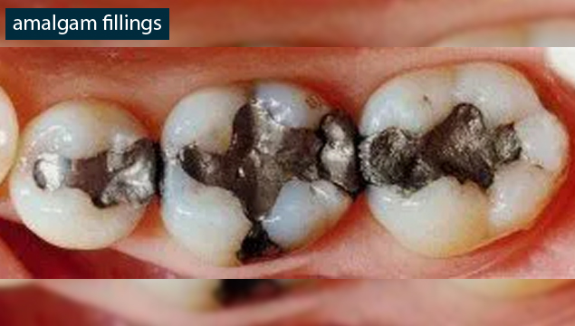 amalgam fillings