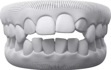 Invisalign Step