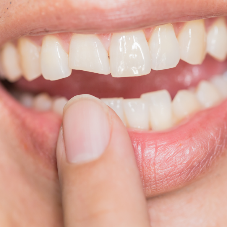 cracked tooth