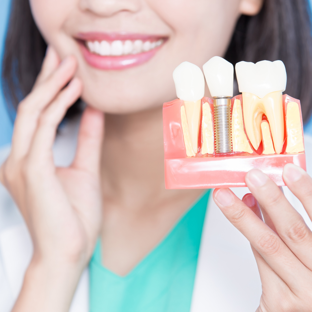 How to Care for Dental Implants